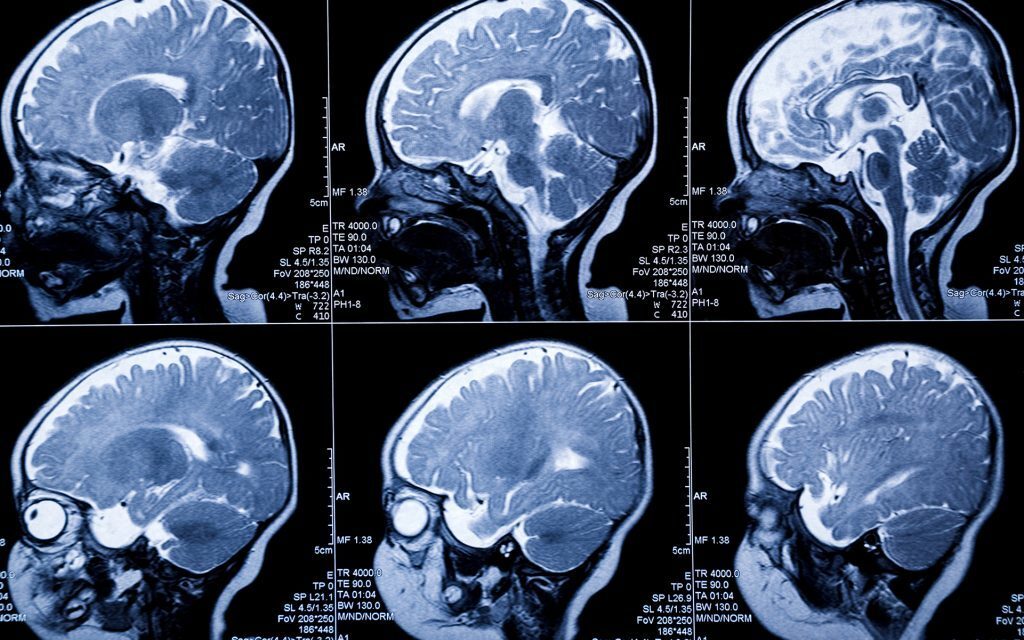 Los efectos en el organismo del consumo constante de THC son múltiples. Este principio activo actúa estimulando la parte del cerebro responsable del placer, liberando dopamina que puede determinar una sensación de relajación, bienestar y euforia.
